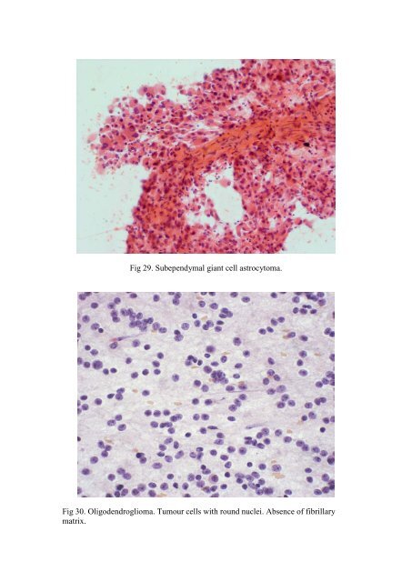 CSF/brain smear cytology - Rcpa.tv