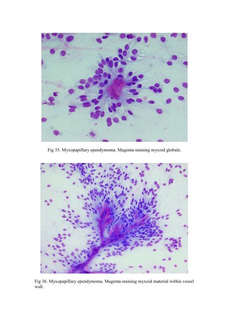 CSF/brain smear cytology - Rcpa.tv