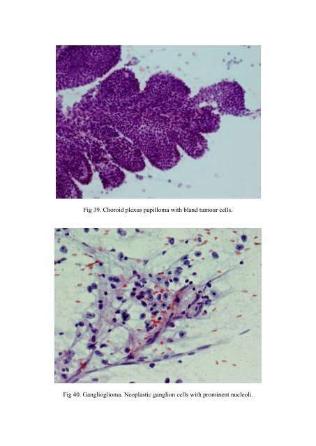 CSF/brain smear cytology - Rcpa.tv