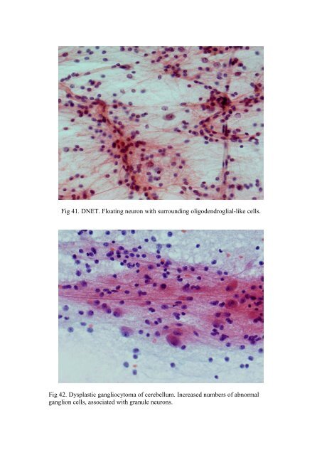 CSF/brain smear cytology - Rcpa.tv