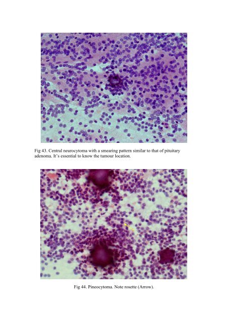 CSF/brain smear cytology - Rcpa.tv