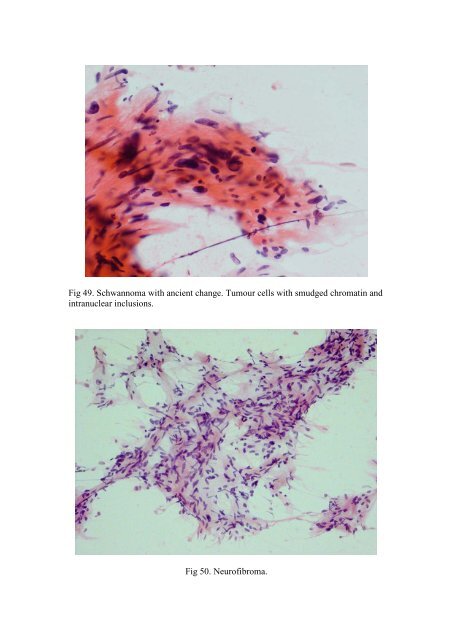 CSF/brain smear cytology - Rcpa.tv