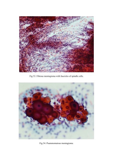 CSF/brain smear cytology - Rcpa.tv