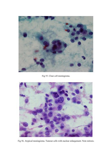 CSF/brain smear cytology - Rcpa.tv