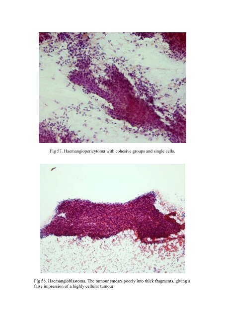 CSF/brain smear cytology - Rcpa.tv