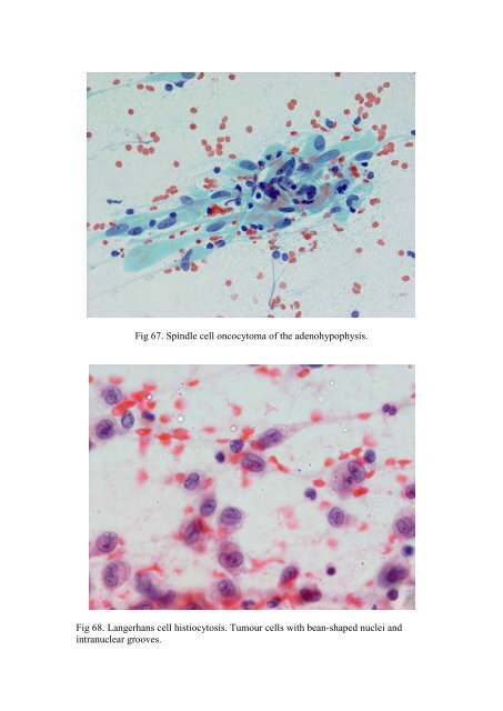 CSF/brain smear cytology - Rcpa.tv