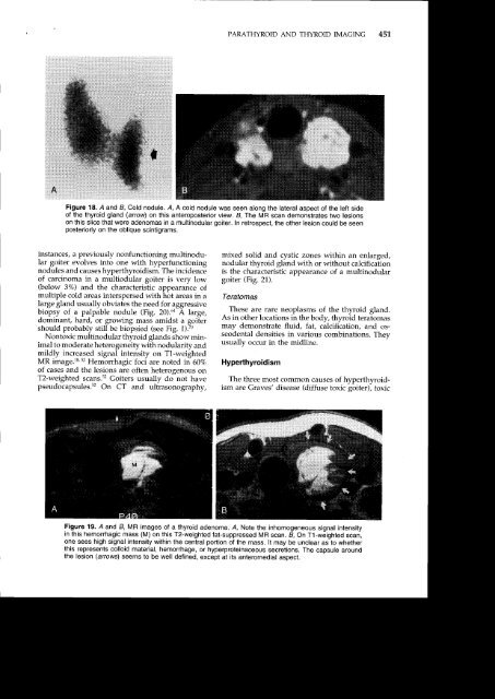 PARATHYROID AND THYROID IMAGING - Neuroradiology