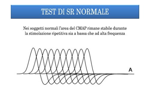 Sindrome di Lambert Eaton: diagnostica e terapia