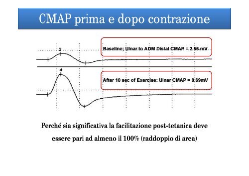 Sindrome di Lambert Eaton: diagnostica e terapia