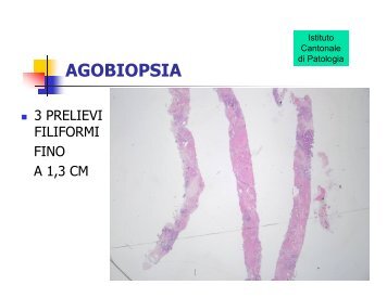 Radiologia ed istologia di lesioni benigne e preneoplastiche nonchÃ© ...