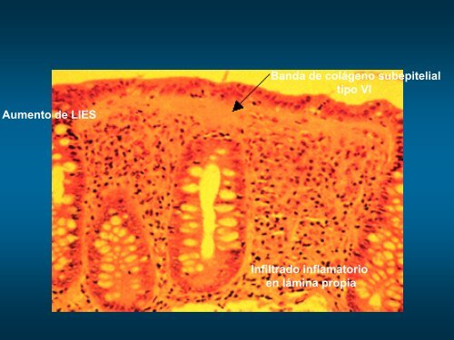 diarrea cronica 2.pdf - ClÃ­nica de GastroenterologÃ­a.