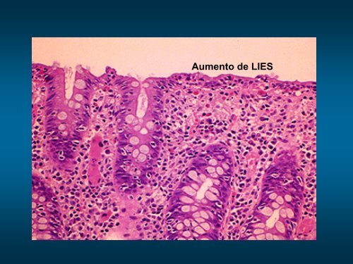 diarrea cronica 2.pdf - ClÃ­nica de GastroenterologÃ­a.