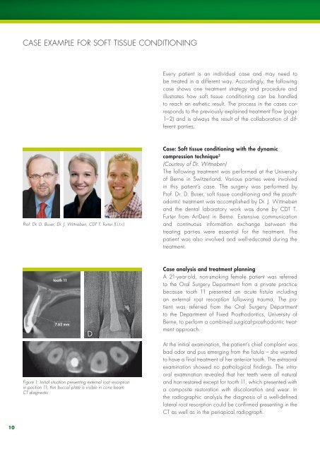 Soft tissue conditioning with the Straumann Â® Bone level implant ...