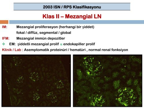 Klas V: MembranÃ¶z Lupus Nefriti