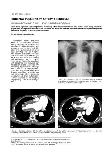 PROXIMAL PULMONARY ARTERY ANEURYSM. B A - rbrs