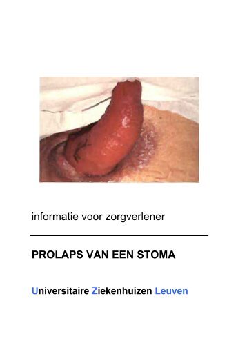 informatie voor zorgverlener PROLAPS VAN EEN ... - UZ Leuven