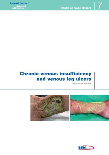 Chronic venous insufficiency and venous leg ulcers - Cutimed