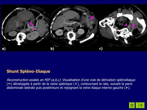 Atlas TomodensitomÃ©trique des Voies de DÃ©rivation ...