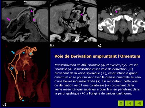 Atlas TomodensitomÃ©trique des Voies de DÃ©rivation ...