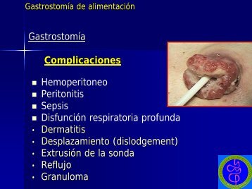 Gastrostomía de Alimentación - Dr. Gerardo Vitcopp - 2° parte - caded