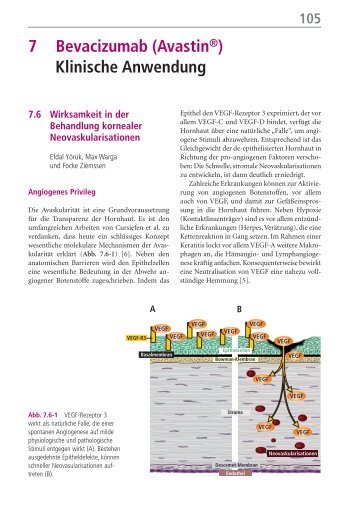 106 7 Bevacizumab (AvastinÃ‚Â®) Ã¢â‚¬â€œ Klinische Anwendung