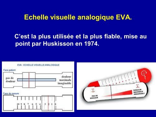 EVALUATION DE LA DOULEUR