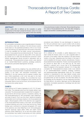 Thoracoabdominal Ectopia Cordis: A Report of Two Cases - JCDR