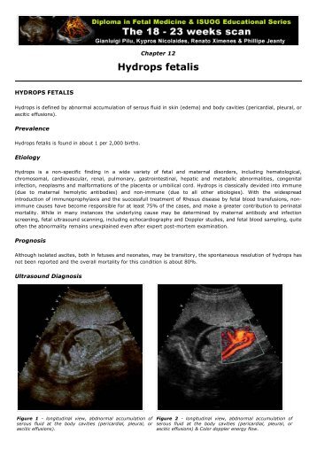 13. Hydrops fetalis