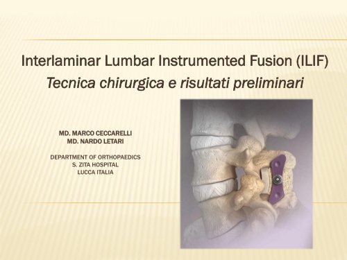 Interlaminar Lumbar Instrumented Fusion (ILIF) Tecnica chirurgica e ...