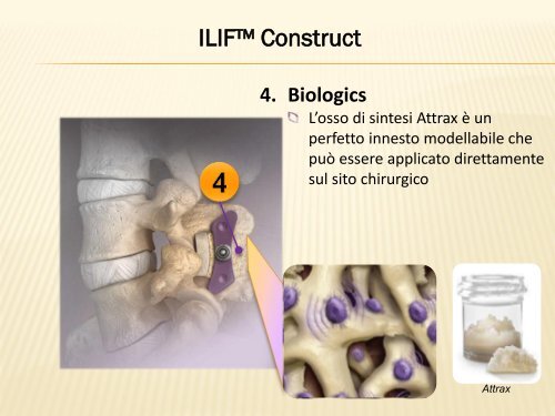 Interlaminar Lumbar Instrumented Fusion (ILIF) Tecnica chirurgica e ...
