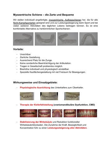 Myozentrische Schiene â die Zarte und Bequeme Vorteile ...