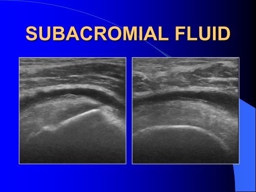 IN OFFICE MUSCULOSKELETAL ULTRASOUND