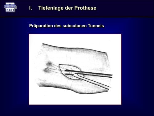 Vortrag (PDF-Datei) - Dialyseshunt