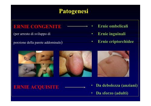 Ernia della Parete Addominale