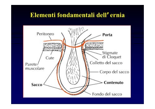 Ernia della Parete Addominale