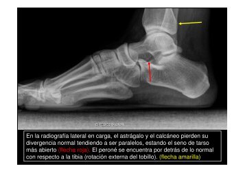 En la radiografía lateral en carga, el astrágalo y el calcáneo pierden ...