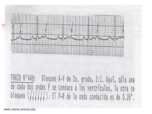 BLOQUEO AURICULOVENTRICULAR - Reeme.arizona.edu