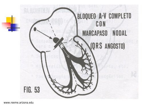 BLOQUEO AURICULOVENTRICULAR - Reeme.arizona.edu