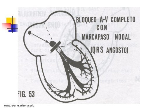 BLOQUEO AURICULOVENTRICULAR - Reeme.arizona.edu