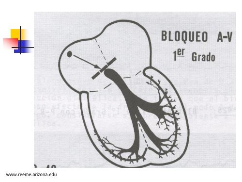 BLOQUEO AURICULOVENTRICULAR - Reeme.arizona.edu