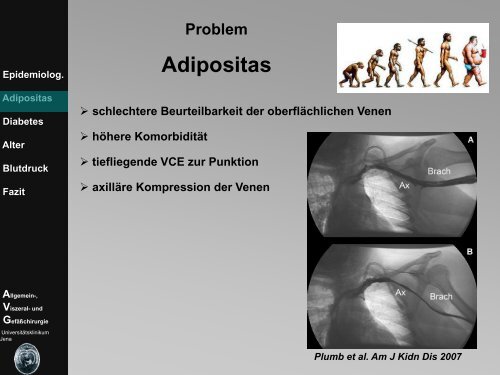 Adipositas - Dialyseshunt