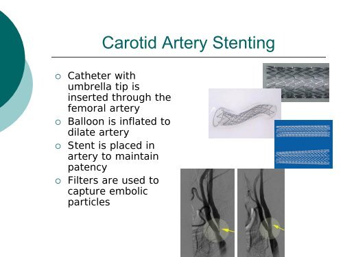 Carotid Artery Endarterectomy vs. Stenting - WVU School of Medicine