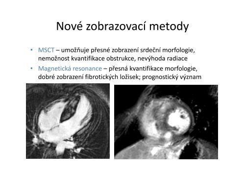 HypertrofickÃ¡ kardiomyopatie â prof. MUDr. Josef Veselka, CSc ...