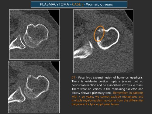 LYTIC EPIPHYSEAL LESIONS - H.U.C.