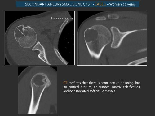 LYTIC EPIPHYSEAL LESIONS - H.U.C.