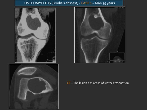 LYTIC EPIPHYSEAL LESIONS - H.U.C.