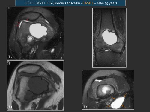 LYTIC EPIPHYSEAL LESIONS - H.U.C.