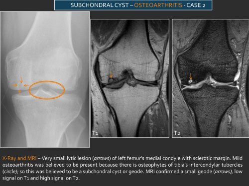 LYTIC EPIPHYSEAL LESIONS - H.U.C.