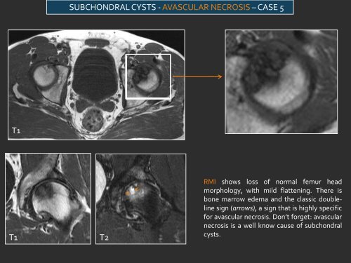 LYTIC EPIPHYSEAL LESIONS - H.U.C.