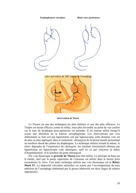 Le reflux gastro-Åsophagien